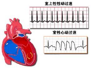 可佩戴的“心房除顫儀”在美研發(fā)成功